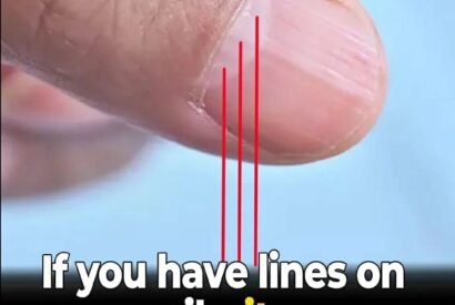 Thumbnail for Doctor Uncovers A Telltale Sign In Your Fingernails That May Predict Your Life Expectancy