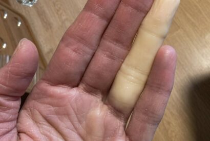 Thumbnail for The Midnight Chill: Why You Might Wake Up with a Pale, Numb Finger (And How to Gently Restore Warmth and Circulation)
