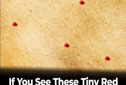 Thumbnail for 🔴 Tiny red dots on your skin aren’t always “just a rash”—and the way they look could reveal an important clue!\n\nDiscover what different red spots may mean and when it’s time to seek help…👇\n\n💬 Have you ever noticed unexplained red dots?