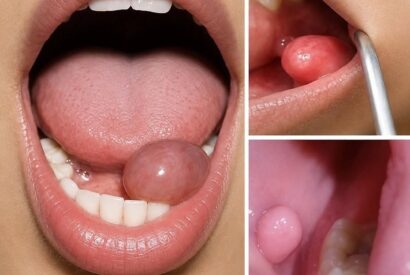 Thumbnail for A Small Lump in the Mouth? Here Are the Early Symptoms You Shouldn’t Ignore