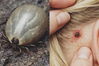 Thumbnail for Found a Weird Bug in Your Child’s Hair? What Parents Should Know