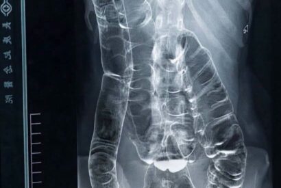 Thumbnail for Chronic Constipation Led This Young Woman to Seek Medical Care – Her X-Ray Told a Surprising Story…