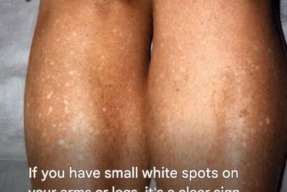 Thumbnail for Why do I get white spots on my skin in the summer and how can I treat them? A dermatologist answers.