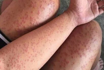 Thumbnail for A Gentle, Science-Backed Guide to Recognizing and Responding to Severe Allergic Reactions