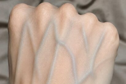 Thumbnail for What the Veins on Your Hands Might Reveal About Your Kidney Health: Separating Myth from Medical Reality