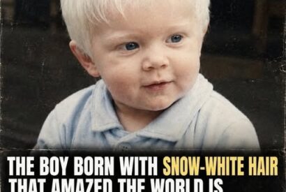 Thumbnail for The Boy Born With Snow-White Hair – His Life Today